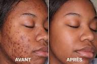 Gel Anti-Imperfections Intense