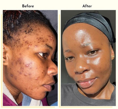 Gel Anti-Imperfections Intense