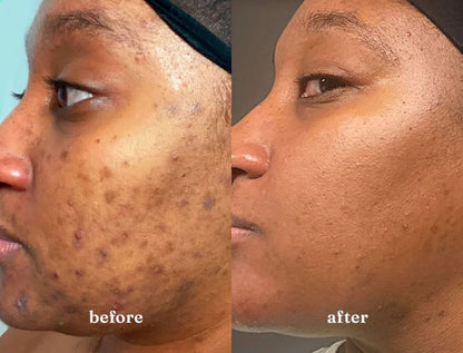 Gel Anti-Imperfections Intense