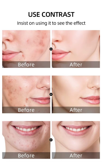 Gel Anti-Imperfections Intense